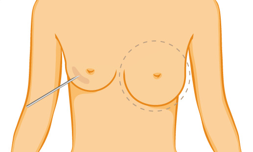 Brustvergrößerung ohne Operation - Hyaluronsäure, Pinkfiller oder Eigenfett