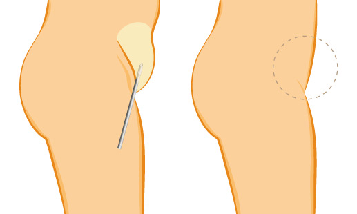 Liposuction Pubic Area WAL Body Jet or SSAL